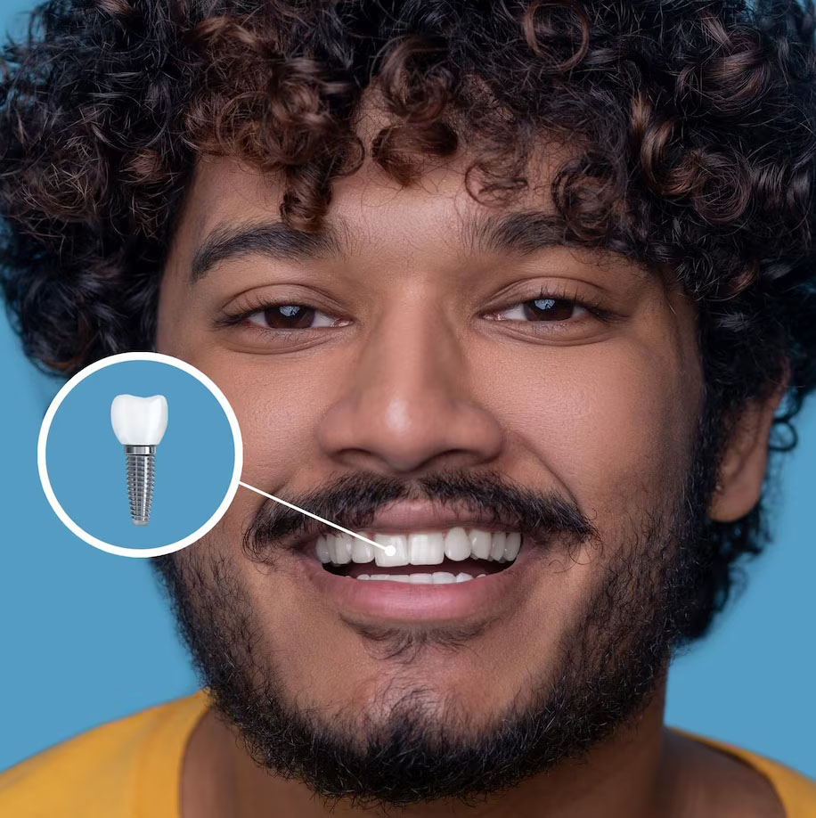 SMART GUIDE-Sablonnal vezérelt implantáció