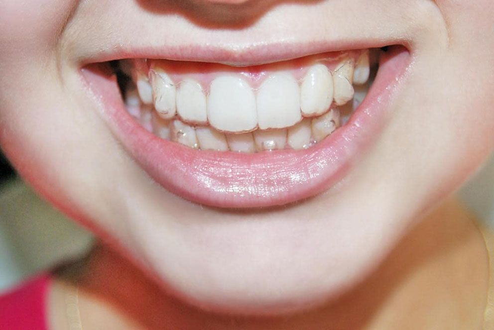 Invisalign attachments