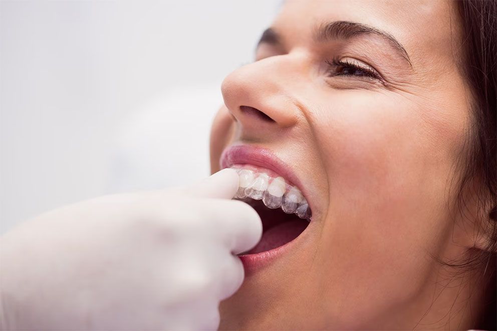 Invisalign láthatatlan fogszabályozó